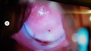 Paciente con Clitorís Aumentado con infección en Vagina
