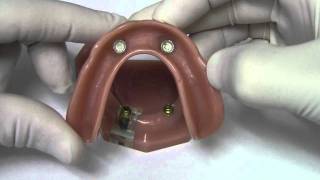Implant Overdenture - Model Demonstration
