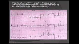 სინუსური ტაქიკარდია / ქოშინი (დისპნოე) / ორსულობა / ბერი-ბერი / თირეოტოქსიკოზი / ანემია