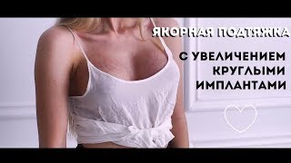 РЕАБИЛИТАЦИЯ ПОСЛЕ Якорной ПОДТЯЖКИ груди при ПТОЗЕ. Хирург Добрейкин Е.А. г. Саратов