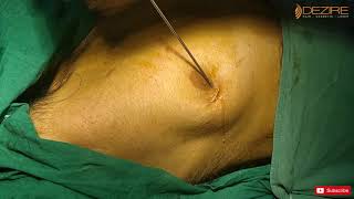 Puffy Nipples Gets VaserLipo & Gynecomastia Surgery In Gurgaon @Dezire Clinic