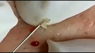 Milia Cytst removal blackhead on face At Home ,Ep#1