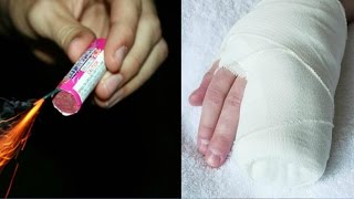 ПЕТАРДА ВЗОРВАЛАСЬ В РУКЕ
