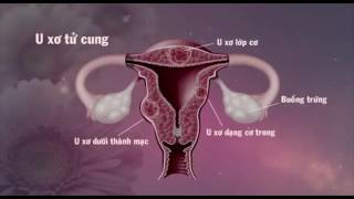 Triệu chứng bệnh u nang buồn trứng, u xơ tử cung