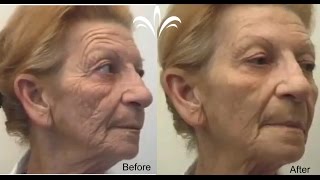 Instantly Ageless™ Абсолютно Безопасная Альтернатива Ботоксу! Эффективная подтяжка лица