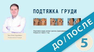 Подтяжка груди в Киеве до и после  | Mastopexy