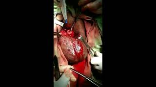 Total Penectomy with Perineal urethrostomy