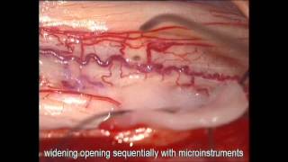 Syringosubarachnoid shunt