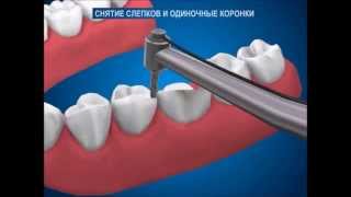 Как отпрепарировать зуб и снять слепки для изготовления коронок  Ортопедическая стоматология