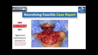 Necrotizing Fasciitis from dental infection