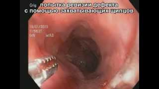 Повреждение пищевода рыбной костью. Эзофагоскопия.