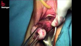 Mangeshikar Uterine-Manipulator (MUM) - Total Laparoscopic Hysterectomy (THL)