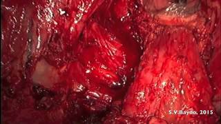 Laparoscopic anterior pelvic exenteration part II