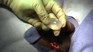 Implantation video