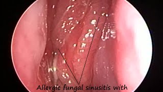 Nose Endoscopy : Allergic Fungal Sinusitis with Sinu-Nasal Polyposis & Post Nasal Discharge (PND)