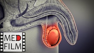 Мужское бесплодие. Пересадка семявыносящего протока © Transplantation of the vas deferens