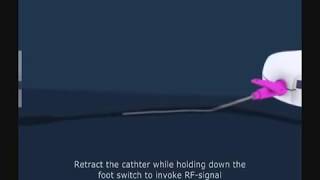 Animation Video of CR12i and CR30i Catheters