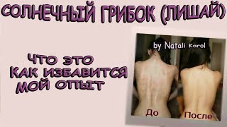 Солнечный лишай (грибок). Что это  Как избавится. Моя история