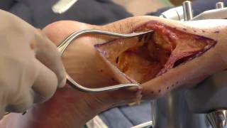 Acumed Ankle Plating System 3 Cadaver Lab Part 2 Posterolateral Approach