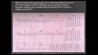 ვიწროკომპლექსიანი ტაქიკარდია (ელექტროკარდიოგრაფიის საფუძვლები) / viwrokompleqsiani taqikardia (ECG)