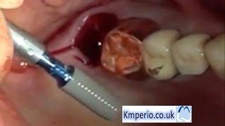 Extraction & Immediate Straumann Implant Placement and Restoration-Upper Right Molar.