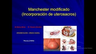 PROLAPSO UTERINO CON CÉRVIX ELONGADO: MANCHESTER MODIFICADO