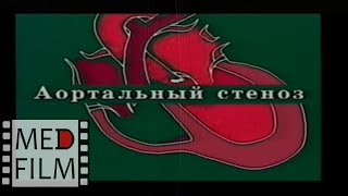Аортальный стеноз. Эхокардиография © Aortic stenosis. Echocardiographic diagnosis