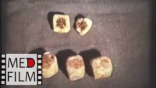 Холецистэктомия "от шейки". Удаление желчного пузыря © Cholecystectomy "from the neck"