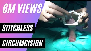 Adult Circumcision Aliskamp by Dr Rizwan Khan,  Pune,  Mumbai,  India, Phimosis Foreskin treatment