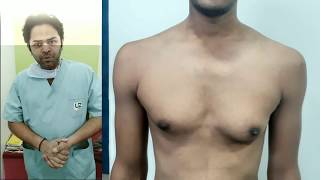 Gynecomastia Surgery for Air Force Medical Exam