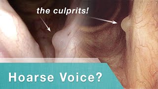 Mucus Retention Cyst: Before and After