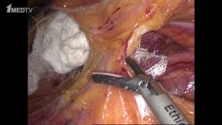 Резекция сигмовидной кишки – видео операции / Sigmoid resection (video operation)