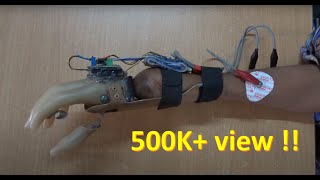 EMG controlled prosthetic hand - Test on Amputee (semi-functional)