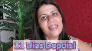 Bariátrica #12: Pós Operatório | Dores| Dieta| Desabafo e Conselhos