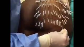 ButtLoad Of Pins: Ass Injections