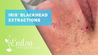 Iris Blackheads Extractions