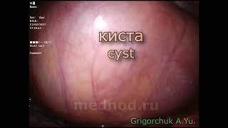 Эндоскопическое удаление огромной кисты вилочковой железы(тимуса). Редкое наблюдение.