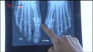 L'opération de l'hallux valgus - Allô Docteurs