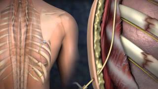 ON-Q Kaburga Kırığı -Truitt   Rib Fractures