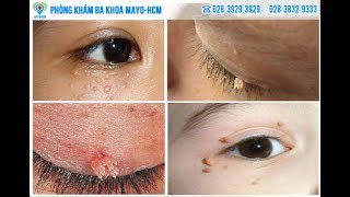 Hình ảnh bệnh sùi mào gà ở mắt