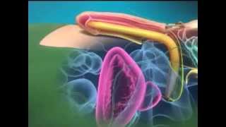 Erectile Dysfunction Treatment: Penile Prosthesis Surgery