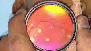 Choroidal tubercles captured with iPhone - No attachment required!