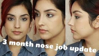 NOSE JOB Q&A  | How much did it cost???? + 3 month Update