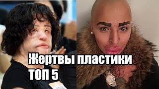 Топ 5 Жертвы Пластической Хирургии | Интересные факты