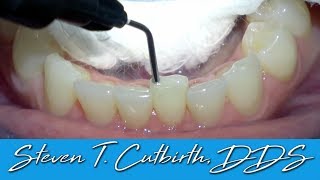 Bonding of Worn Anterior Tooth - Dental Minute with Steven T. Cutbirth, DDS