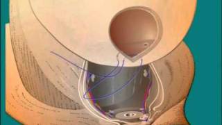 Nerve sparing open radical retropubic prostatectomy