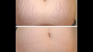 Лазерная шлифовка растяжек, рубцов, шрамов Tel:012 498 80 85 www.dermalife.az