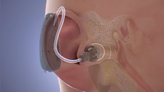 УШНЫЕ ВКЛАДЫШИ для слуховых аппаратов