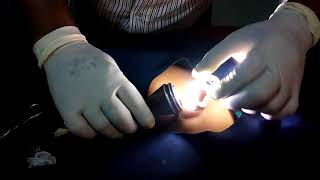 Alisklamp Circucision Done by Dr Fazal Ahmed.সেলাই ও বেন্ডেজ বিহীন,রক্তপাতহীন কসমেটিক খৎ্না।