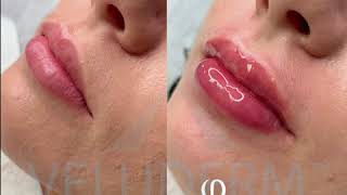 Hyaluronic Pen Veluderm